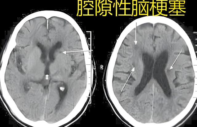 什么是腔隙性脑梗塞？脑梗的预防和治疗方法有哪些？早知早受益