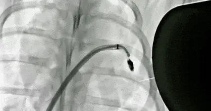 “液体封堵”，磁流体机器人破解临床难题 | 科技前线