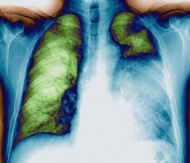 饮食不规律是导致肺癌的原因吗