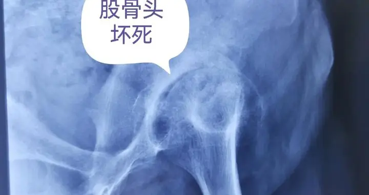 祖传中医说句实在话：股骨头坏死保守治好后，还会不会复发？