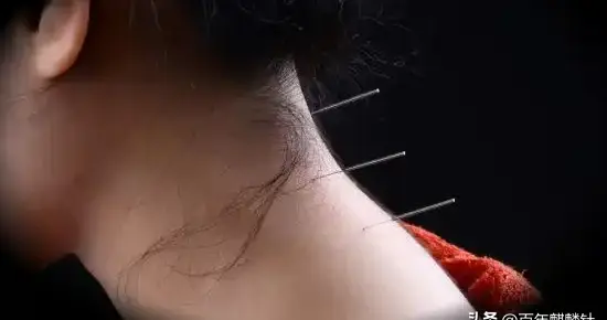 细细银针激活身体的自愈力：针灸的奇妙科学之旅