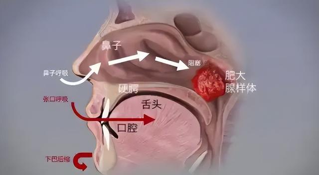 消腺样体肥大不难，坚持4件事很重要，不想手术的可以看看