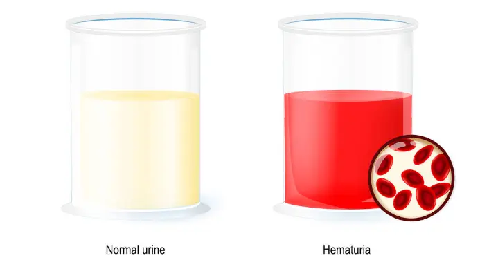 尿检发现血尿如何应对？