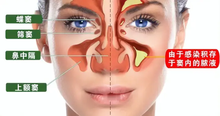 眉山老乡警惕， 今日3台鼻窦手术2台霉菌感染，50+岁大姐频发！