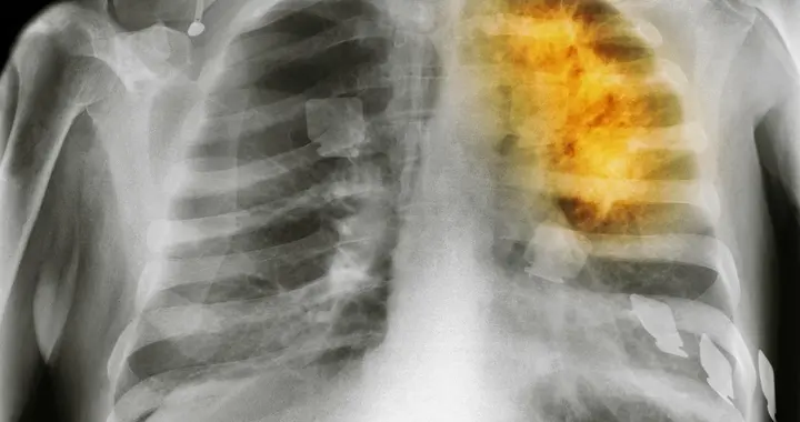 清肺益气，开痰软坚调理右中心型肺癌