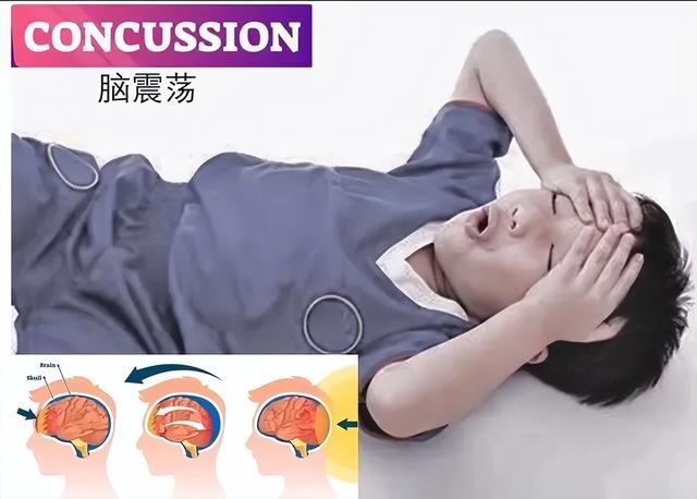 脑震荡有哪些症状？如何防范？看过来~~