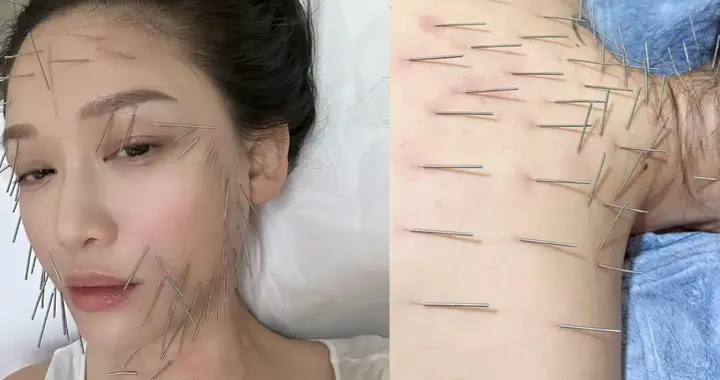 容貌焦虑？何穗、陈乔恩先后做面部针灸，全身布满小针太震撼