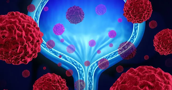 前列腺癌并非毫无征兆？身体若有这4个信号，建议尽早检查