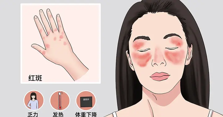 全球首例！中国一针CAR-T细胞攻克红斑狼疮，6周彻底清除病灶