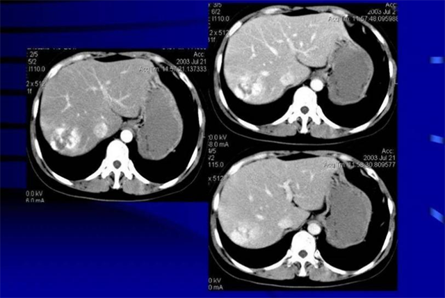 肝癌来袭，皮肤先知！如皮肤出现3大先兆症状，请警惕肝癌来临！
