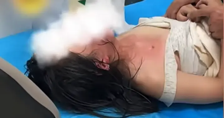 女孩煮面被烫伤，爸爸火速就医害娃毁容，医生一句话让爸崩溃