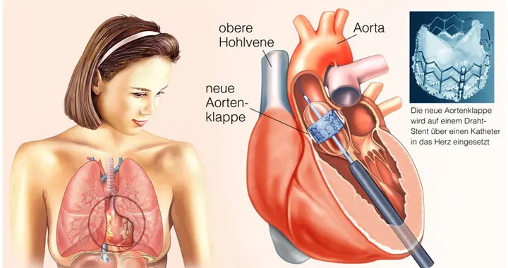 国内将逐渐停止“心脏支架”手术？做完人就废了？医生告诉您真相