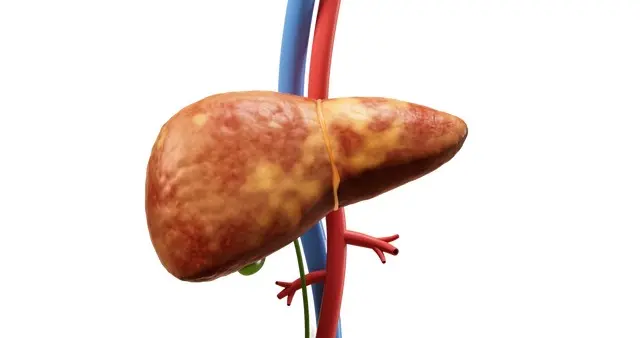 起床后出现这 4 个表现，多半肝硬化还没控制住！