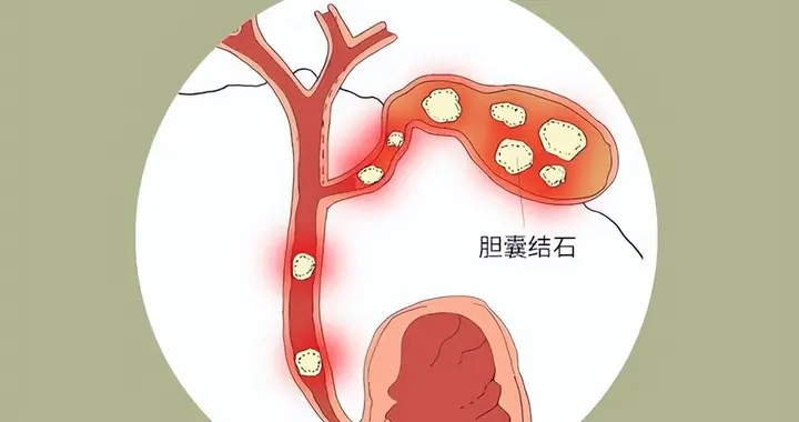 40岁以后人群预防胆结石，出现发热、黄疸时，须立即就医