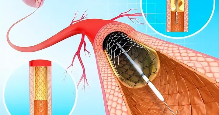 后别大意：熬过3个危险期才算稳，6个细节决定恢复质量