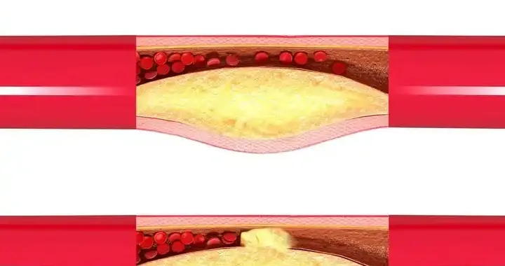 猝死发生前一个月，身体就疯狂报警！