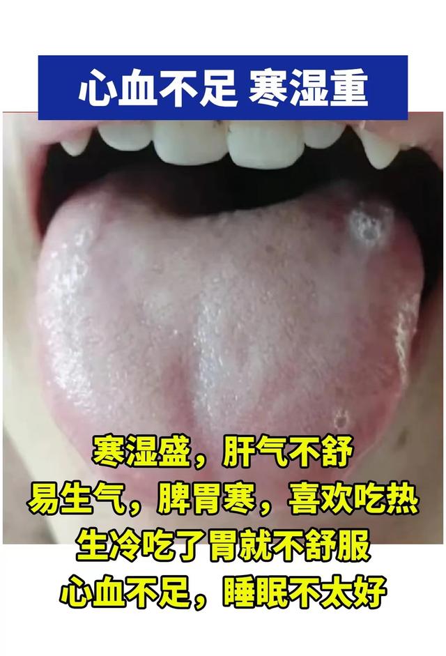 潘医生舌诊—实战分析：心血不足，寒湿重，寒湿盛，肝气不舒