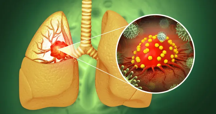 肺腺癌患者越来越多，医生再三提醒：家里的7物危害大，尽早扔掉