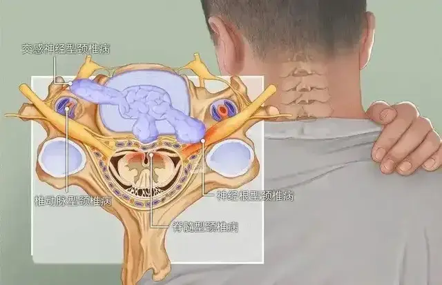 麒麟针“三三法”特色治疗神经根型颈椎病