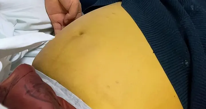 医生提醒：一旦查出脂肪肝，就算只是轻度，平时也要注意3个细节