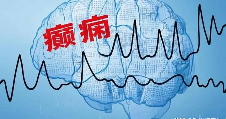 治疗癫痫一定要找到原因吗？