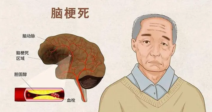 脑梗与散步有关？医生多次提醒：55 岁以后，散步时要多注意这几点