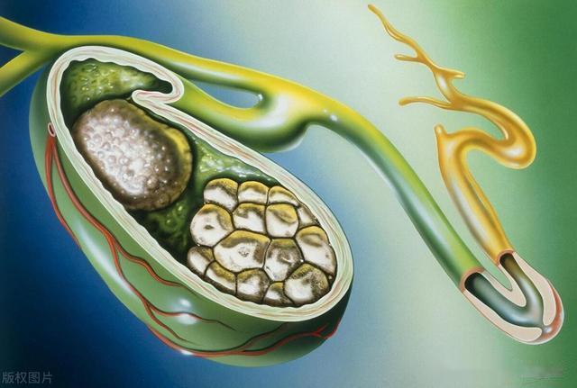 排石汤中的常用这三味药，一排一化一消，搞定你体内的结石！