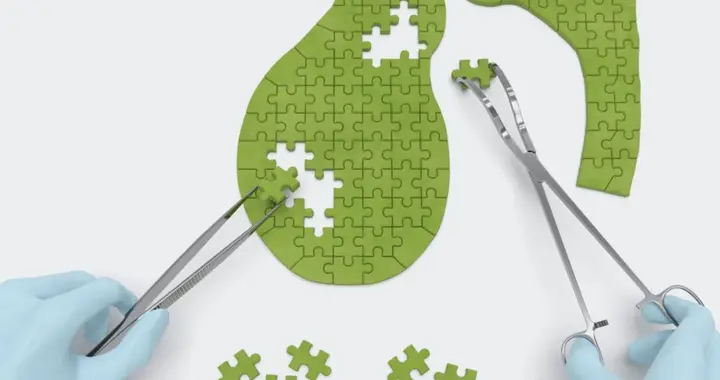 被国际指南淘汰十几年，保胆取石手术为何仍然风靡中国？