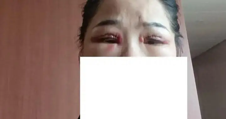 从600多元变成5万元，57岁保洁员掏空积蓄做医美，双眼皮手术后眼睛红...