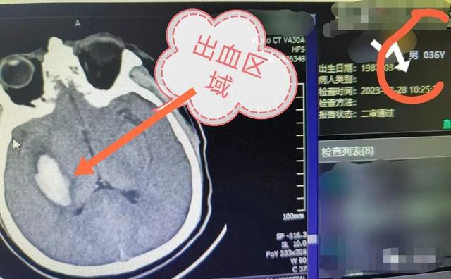 3天3个脑出血，38岁、36岁、最小的才24岁！3个人有3个共同点！