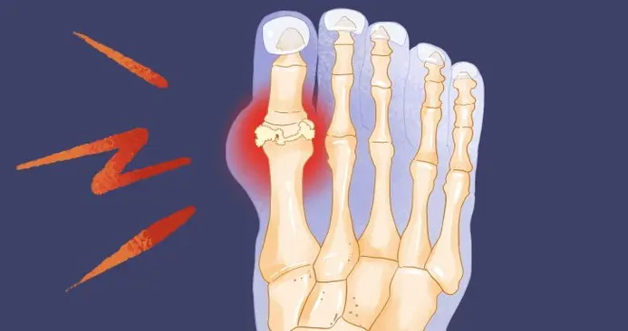 高尿酸最怕你这样吃！饭桌上这5类食物要多吃，尤其第一个