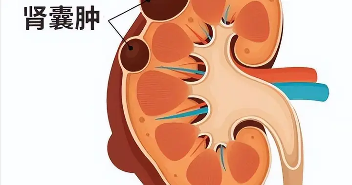 人不会无缘无故患肾囊肿！医学研究：肾囊肿病人，背后有4大原因