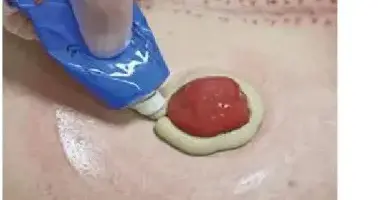 我的直肠癌经历之八。