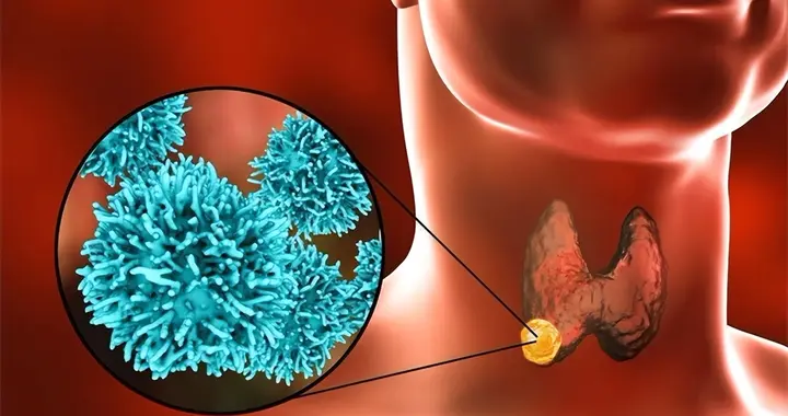 人不会无故长甲状腺结节！医生实话：甲状腺结节，离不开这几点