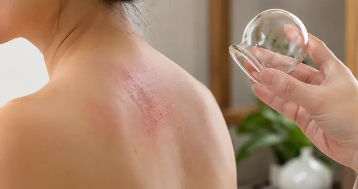 拔罐并非人人适合，皮肤状态和体质差异都要考虑