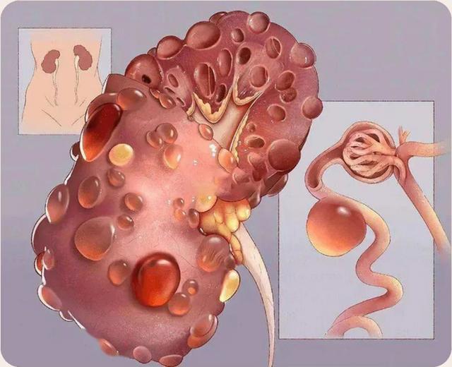 哈工大发现：肾脏有囊肿的人，身体一般或可能有八个表现？