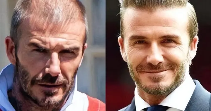 涂“糖”就能生发？英国科学家证实：20天长出90％毛发