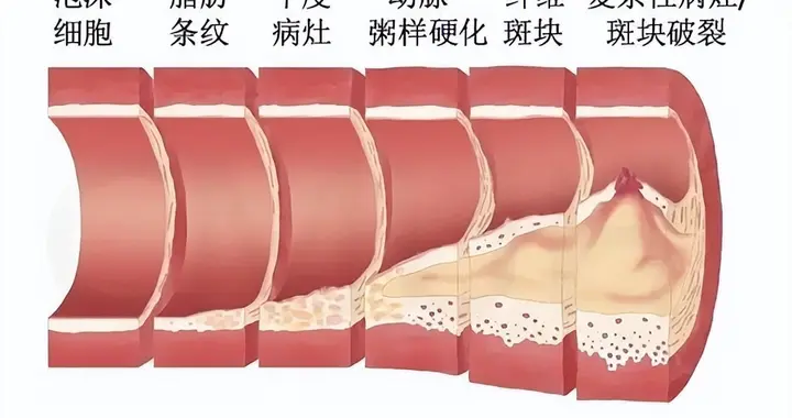 上海45岁女子，血管狭窄75%成功降到36%，医生：3个习惯值得借鉴