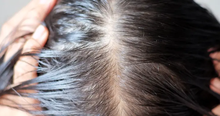 脱发与缺锌有关？医生：常吃黑豆芝麻，不如多吃这3物给毛囊减压