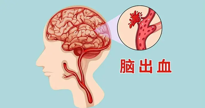 人为什么会得脑出血？原来脑出血是这样来的，现在知道还不晚