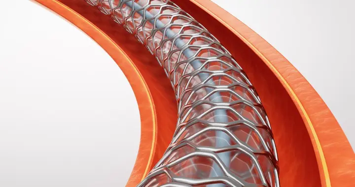 心脏支架的副作用真那么恐怖？今天5分钟给你解释清楚