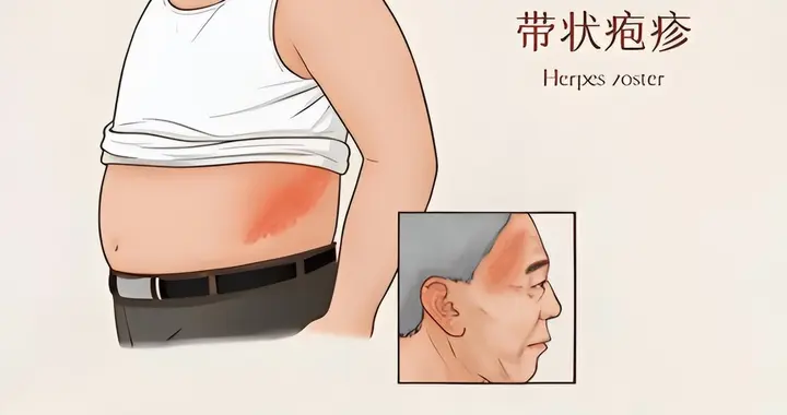 人不会无故患带状疱疹！研究发现：得带状疱疹的人，离不开这6点