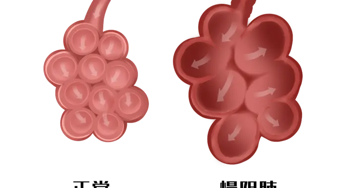 世界慢性阻塞性肺病日 | 呼吸不顺畅，当心慢阻肺