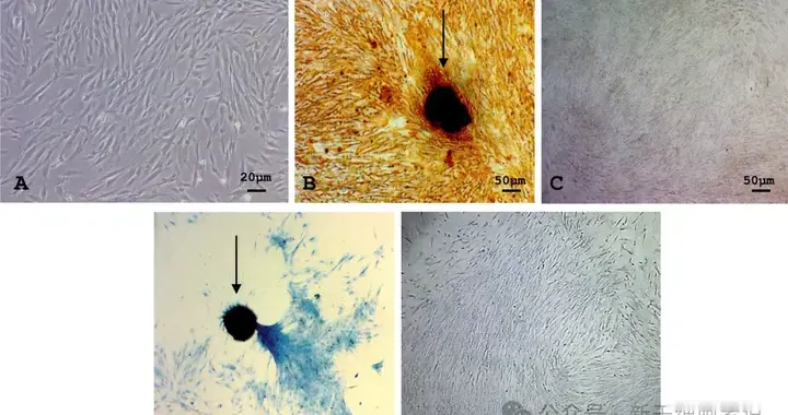 人牙髓干细胞治疗亨廷顿氏病的II期试验：一项随机、双盲、安慰剂对照研究