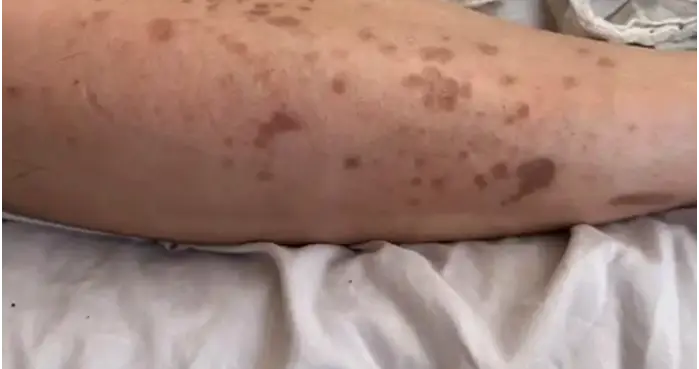 肠菌移植（FMT），能破解糖尿病皮肤病变难题吗？