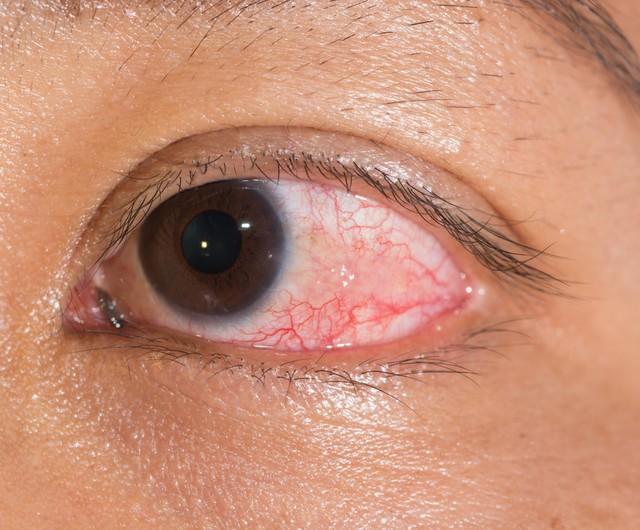 眼干、眼涩、眼模糊，教您三招清火、养肝、明目，缓解眼部不适