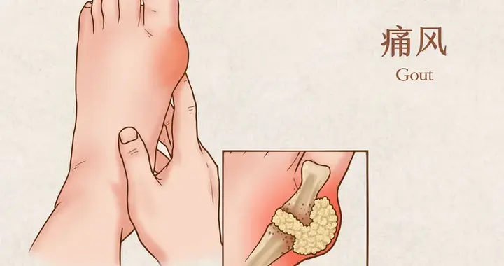 凌晨两点被“刀割”痛醒！中国1500万痛风患者，6成竟不到35岁