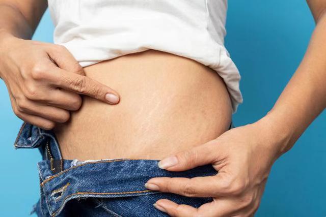 快速减肥会出现肥胖纹？如何去除？医生提醒：做好这2点更重要