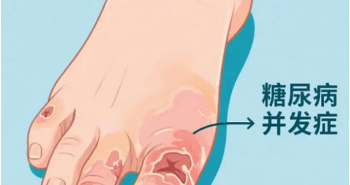 肠菌移植（FMT）：糖尿病足创面愈合的“新钥匙”？