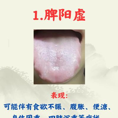 中医男科杜大夫：齿痕舌别只怪湿气重，5
